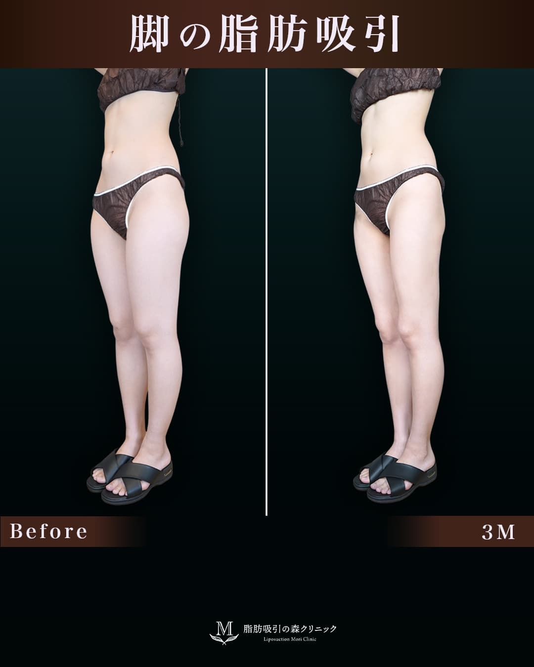 162cm 49kg 20代　太もも•膝•臀部　術後3ヶ月の症例写真
