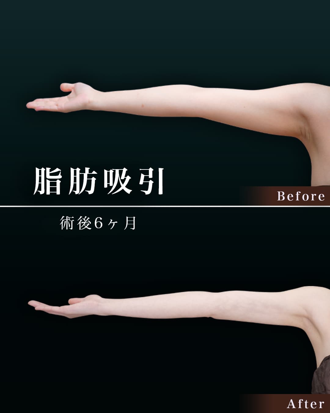 156cm 49kg 20代　二の腕・肩　　術後6ヶ月の症例写真