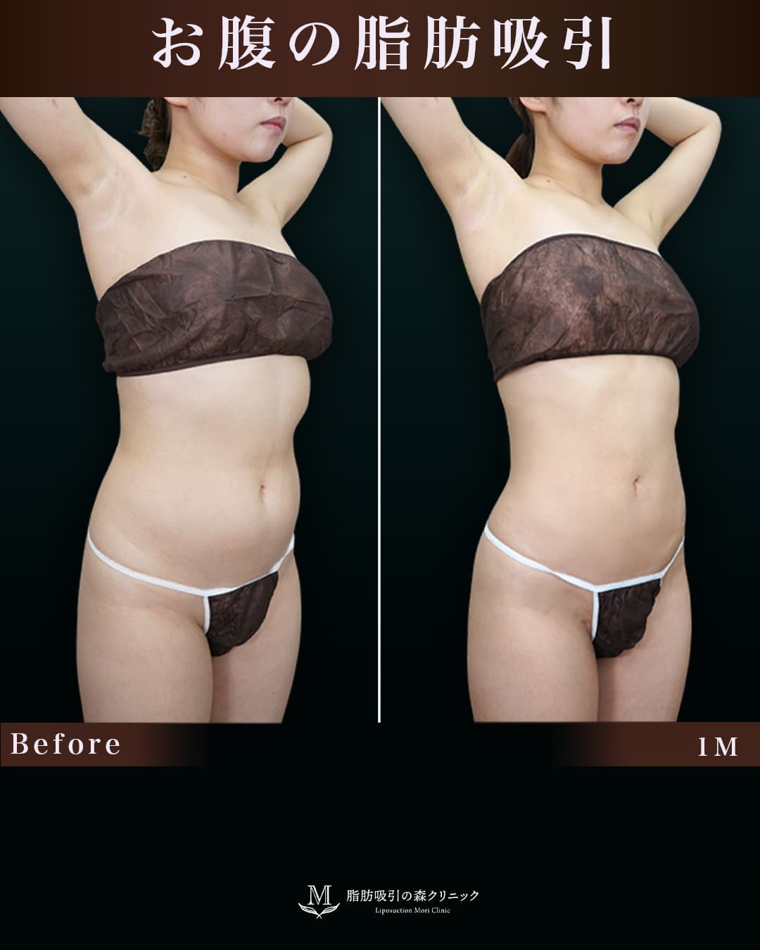 152cm 49kg 30代　腹•腰の症例写真
