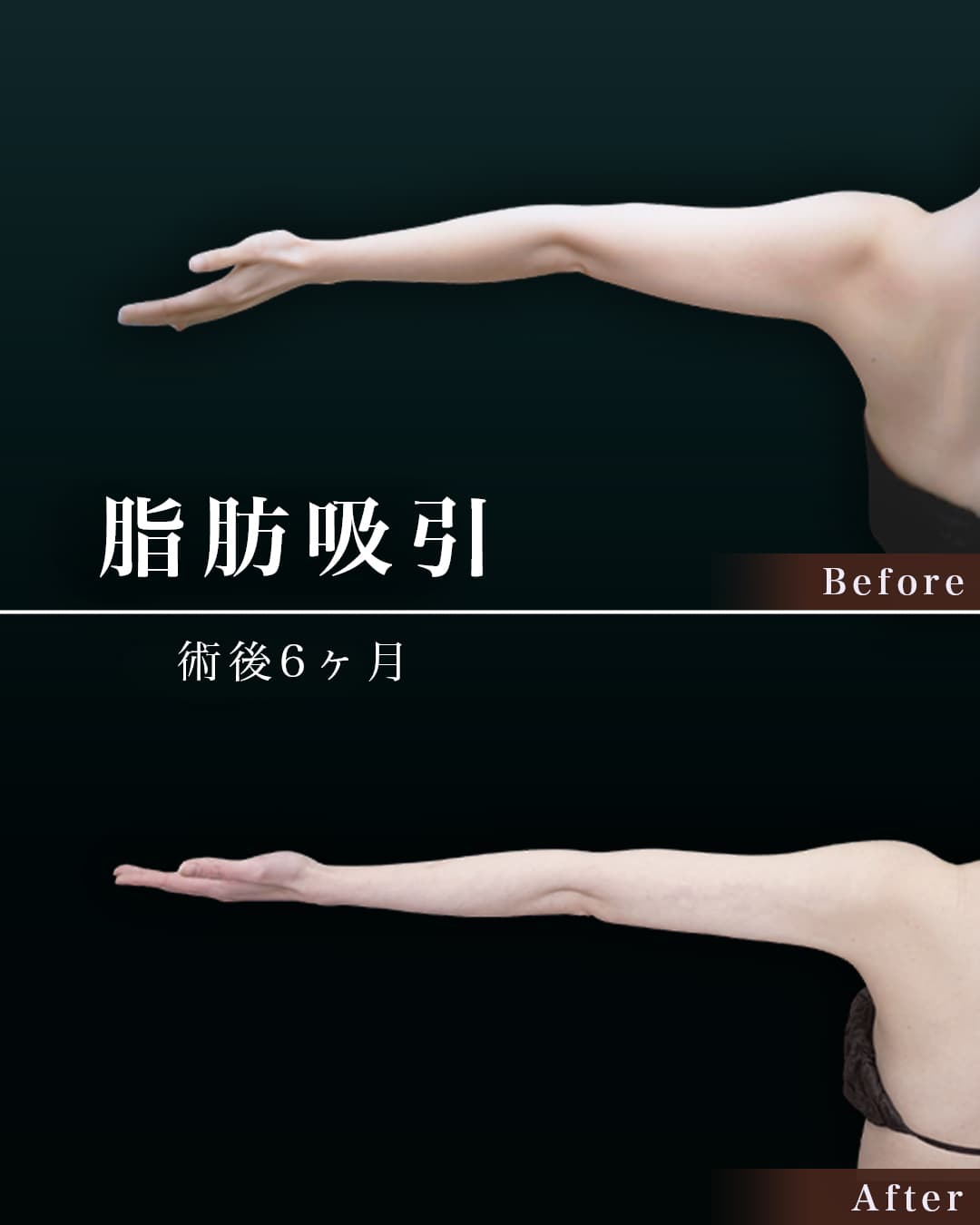 156cm 49kg 20代　二の腕・肩　　術後6ヶ月の症例写真
