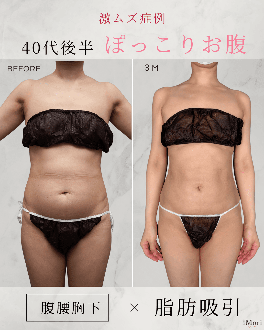 161cm 55kg 40代 腹•腰•胸下の症例写真