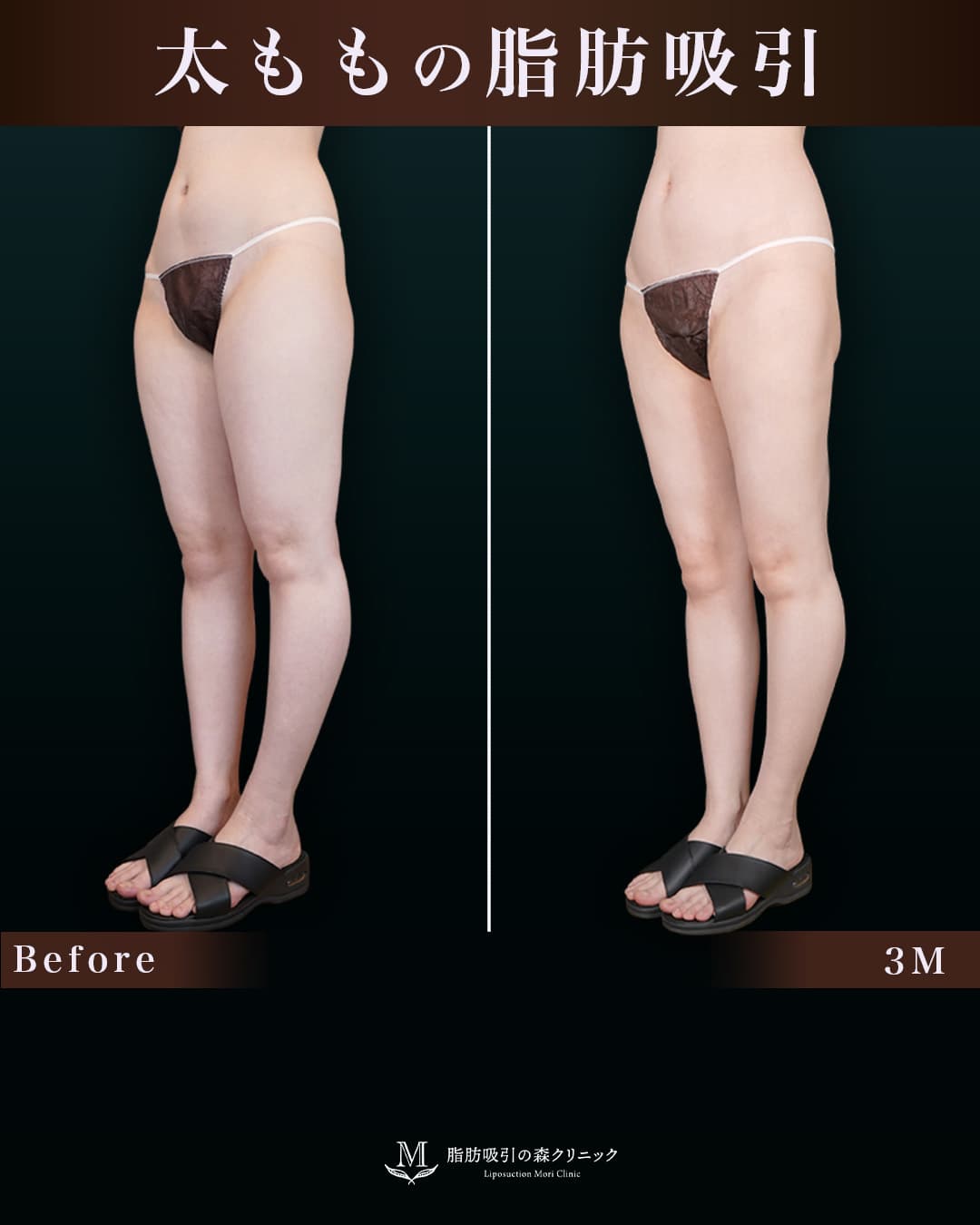 159cm 52kg 20代 太もも•膝•臀部 術後3ヶ月の症例写真