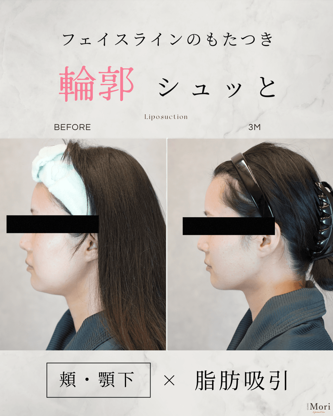 154cm 53kg 30代 頬・顎下 術後3ヶ月の症例写真