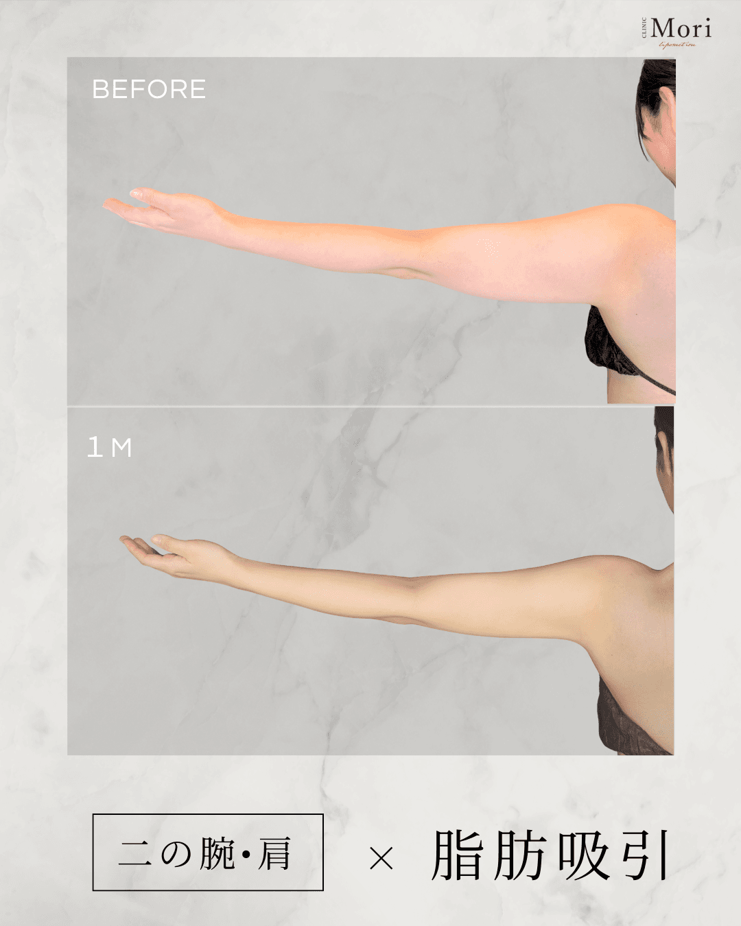 162cm 43kg 20代 二の腕全周 術後3ヶ月の症例写真