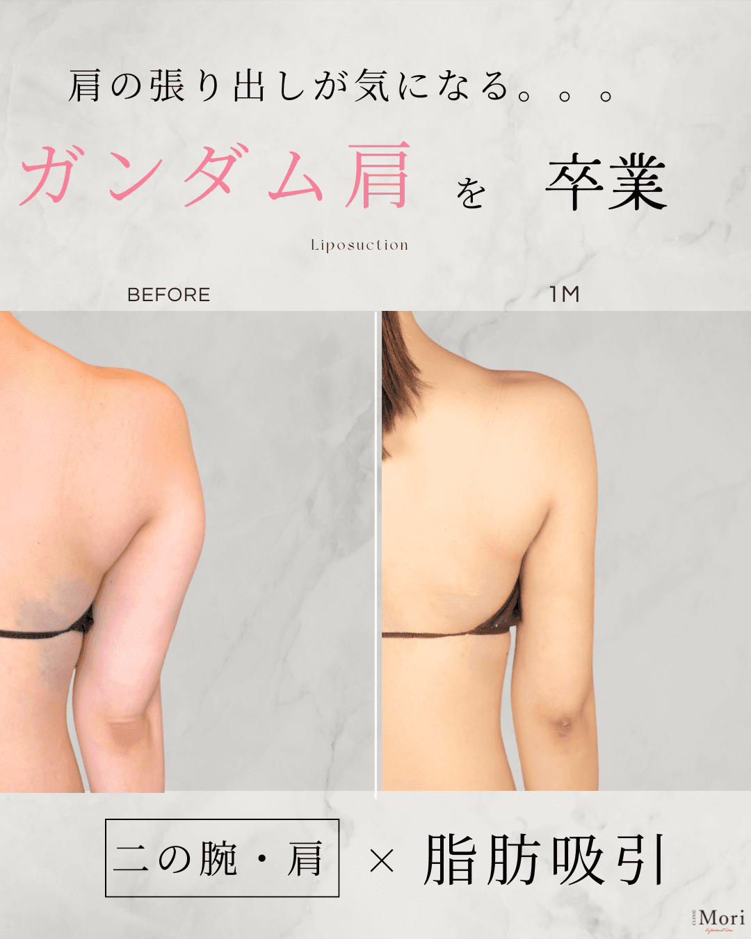 162cm 43kg 20代 二の腕全周 術後3ヶ月の症例写真