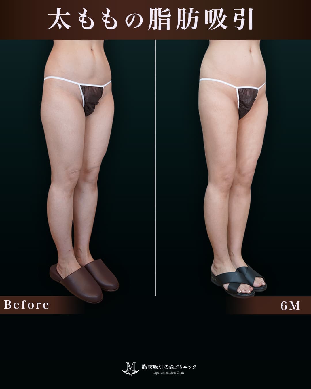 156cm 49kg 40代 太もも•膝•臀部 術後6ヶ月の症例写真