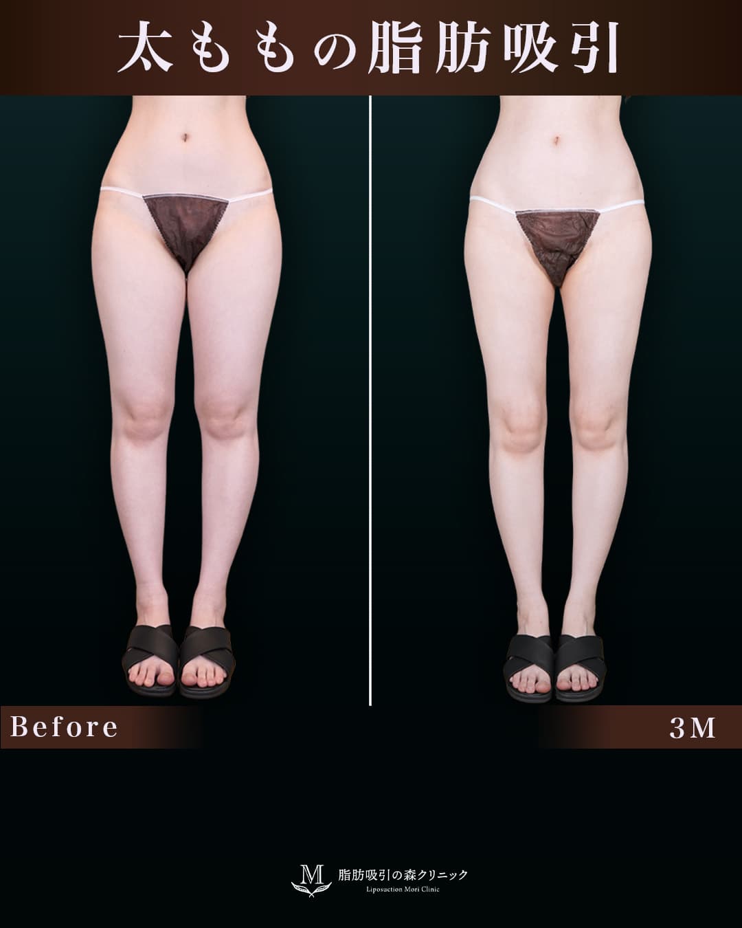 159cm 52kg 20代 太もも•膝•臀部 術後3ヶ月の症例写真