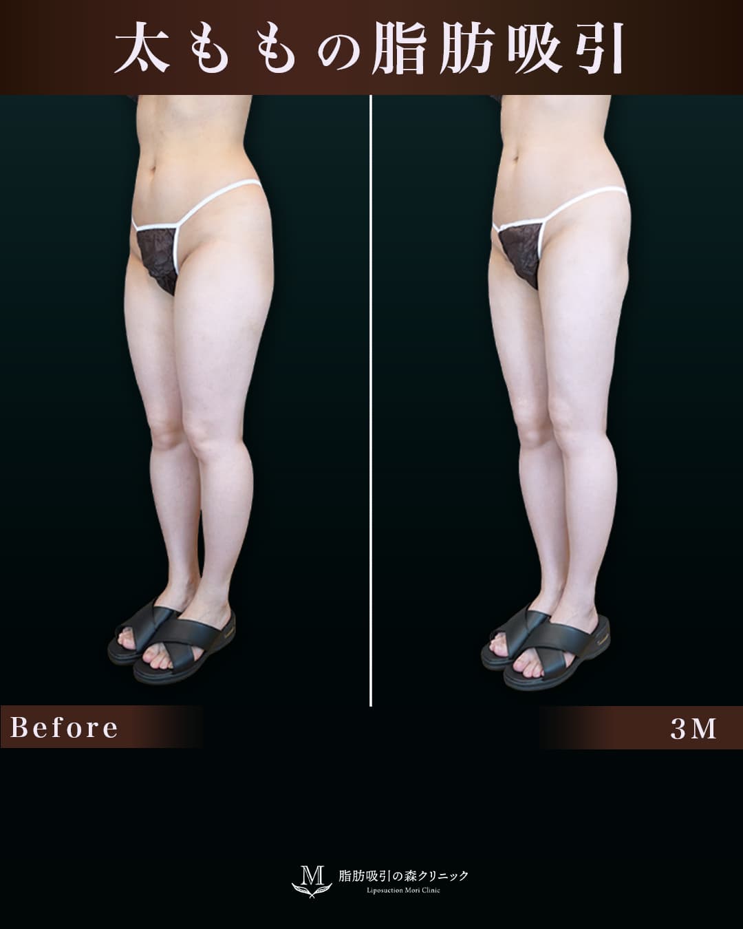 153cm 48kg 30代 太もも•膝•臀部 術後3ヶ月の症例写真