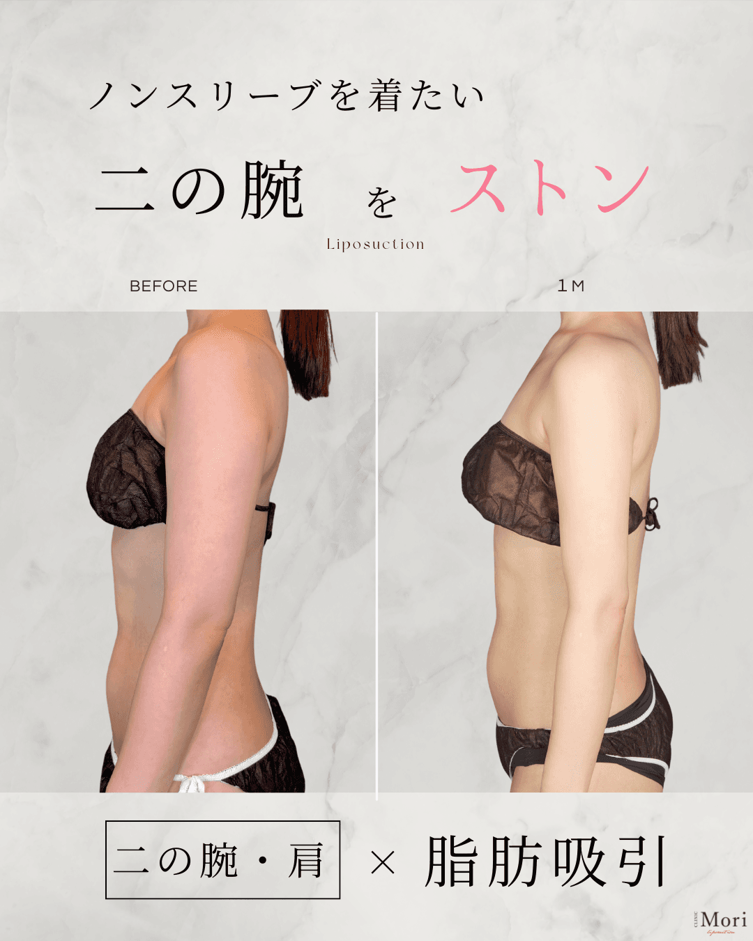 162cm 43kg 20代 二の腕全周 術後3ヶ月の症例写真