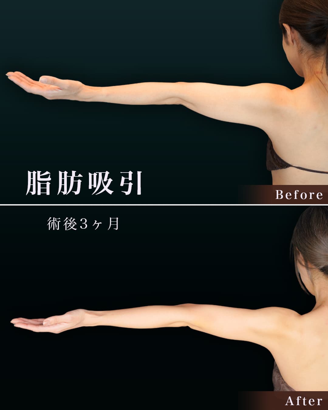 156cm 49kg 40代 二の腕・肩 術後3ヶ月の症例写真