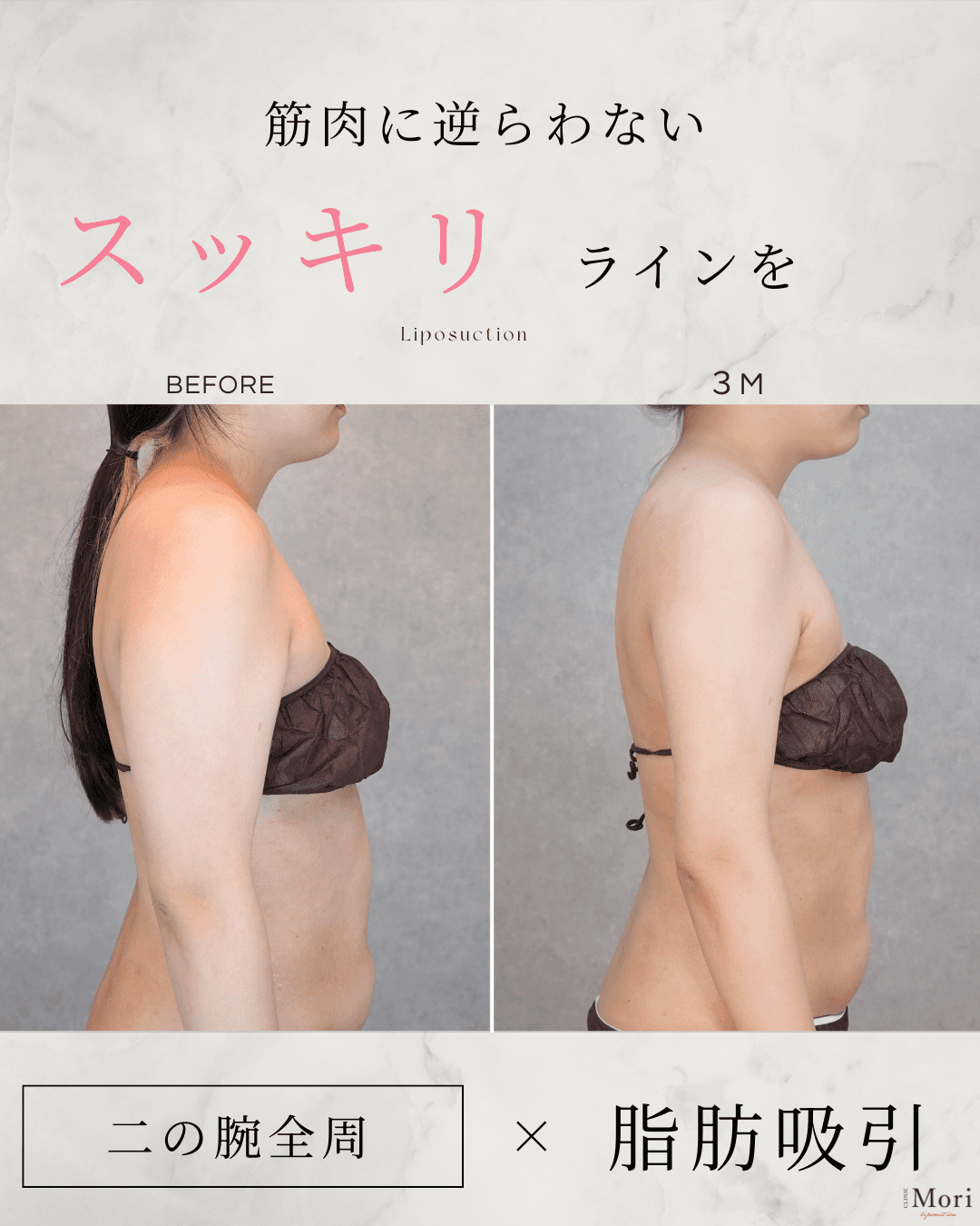 156cm 49kg 40代 二の腕・肩 術後3ヶ月の症例写真