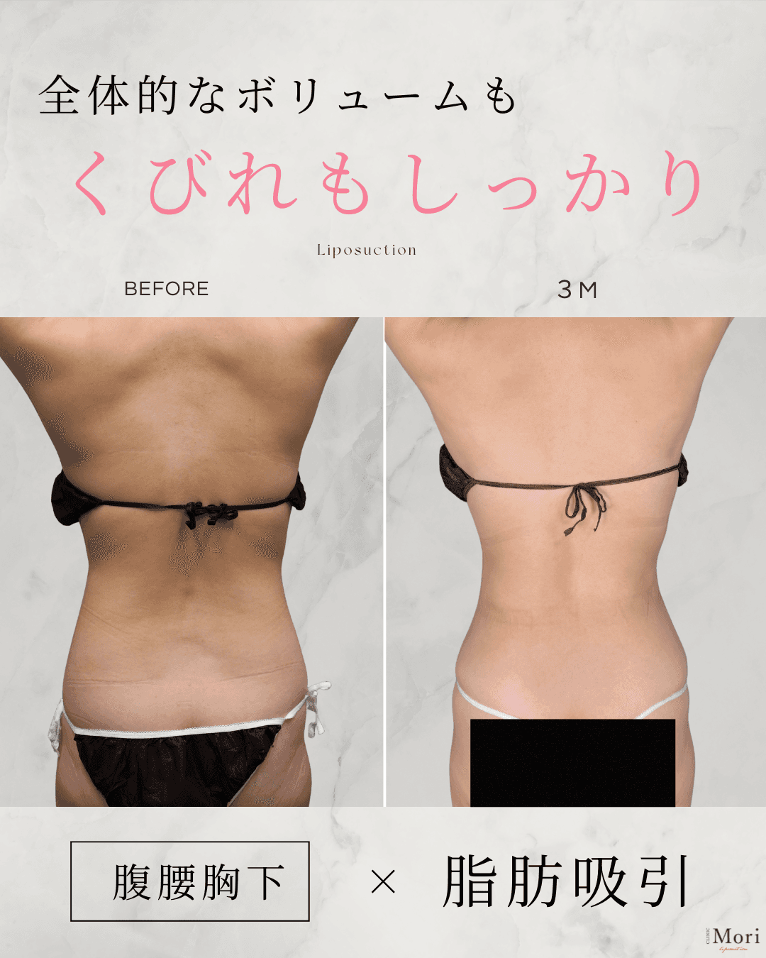 161cm 55kg 40代 腹•腰•胸下の症例写真