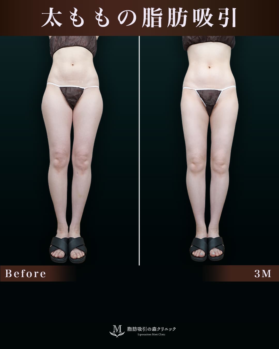 162cm 52kg 30代 太もも•膝•臀部 術後3ヶ月の症例写真