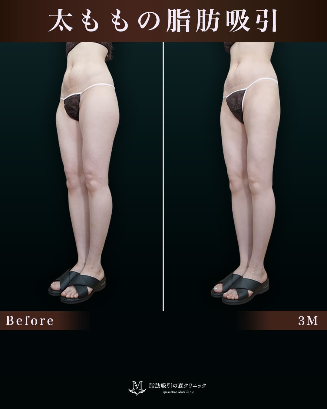 162cm 52kg 30代 太もも•膝•臀部 術後3ヶ月の症例写真