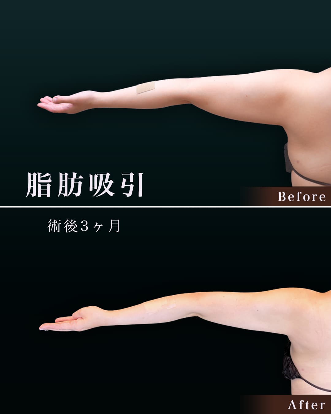 170cm 76kg 30代 二の腕全周 術後3ヶ月の症例写真