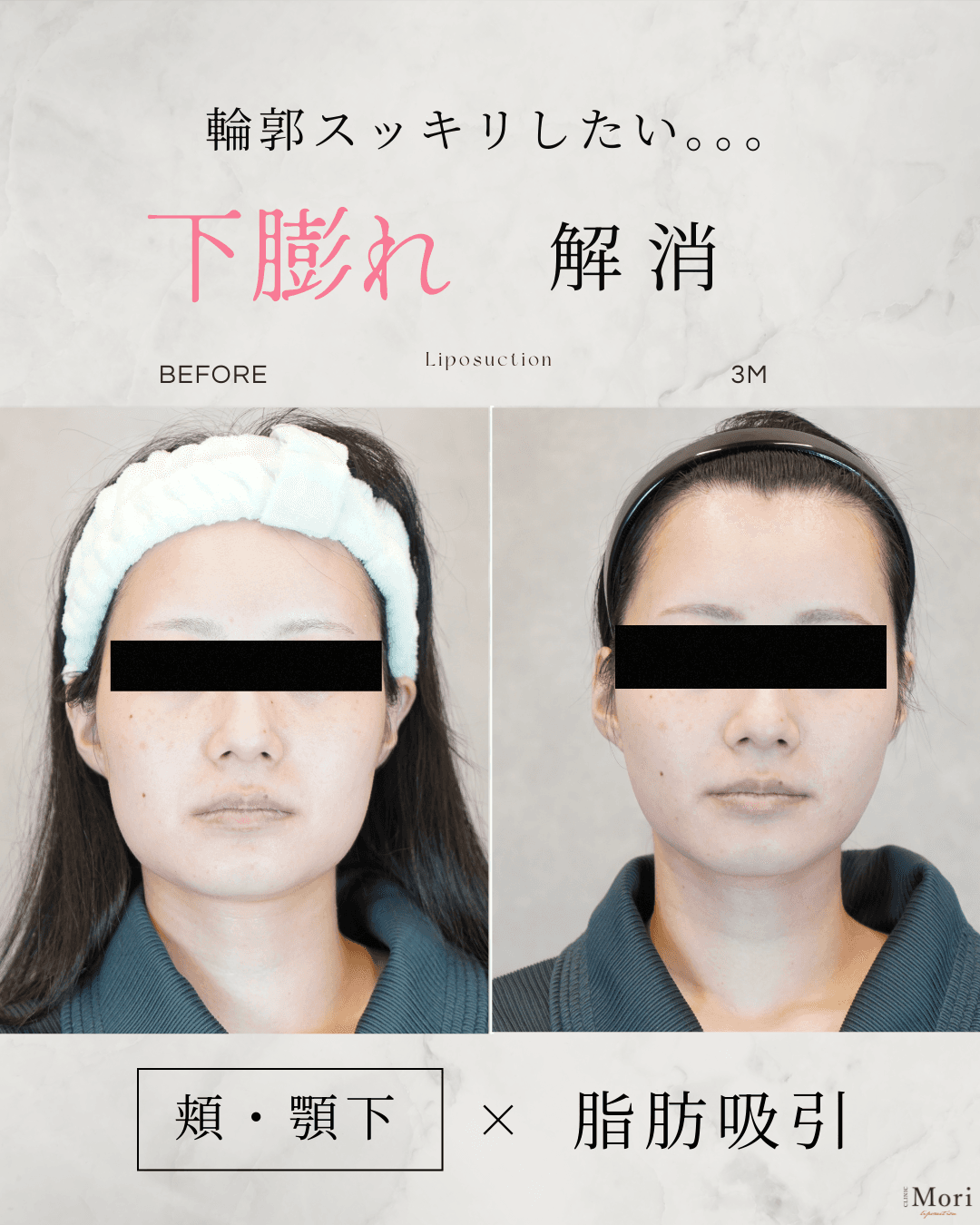 154cm 53kg 30代 頬・顎下 術後3ヶ月の症例写真