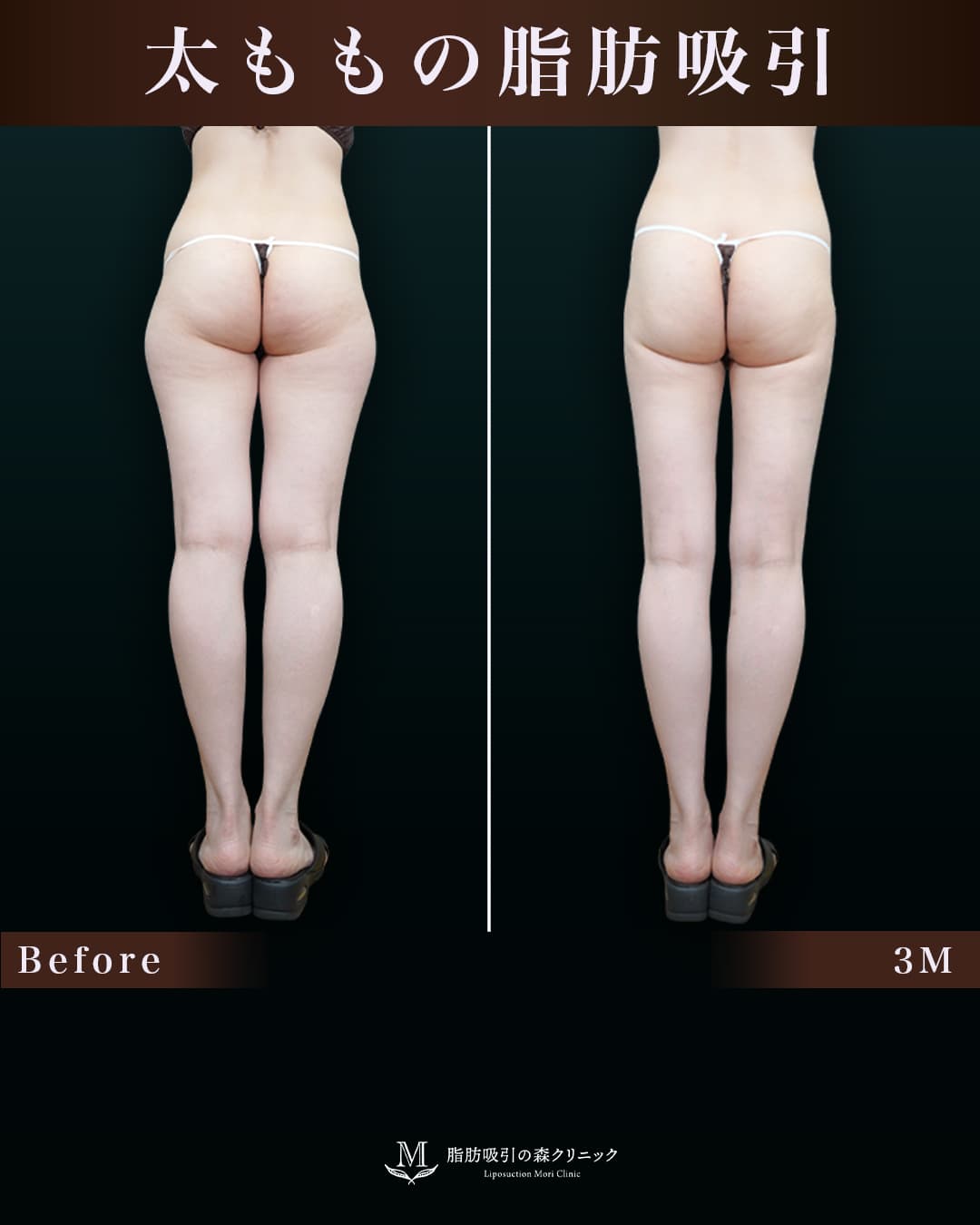 162cm 52kg 30代 太もも•膝•臀部 術後3ヶ月の症例写真