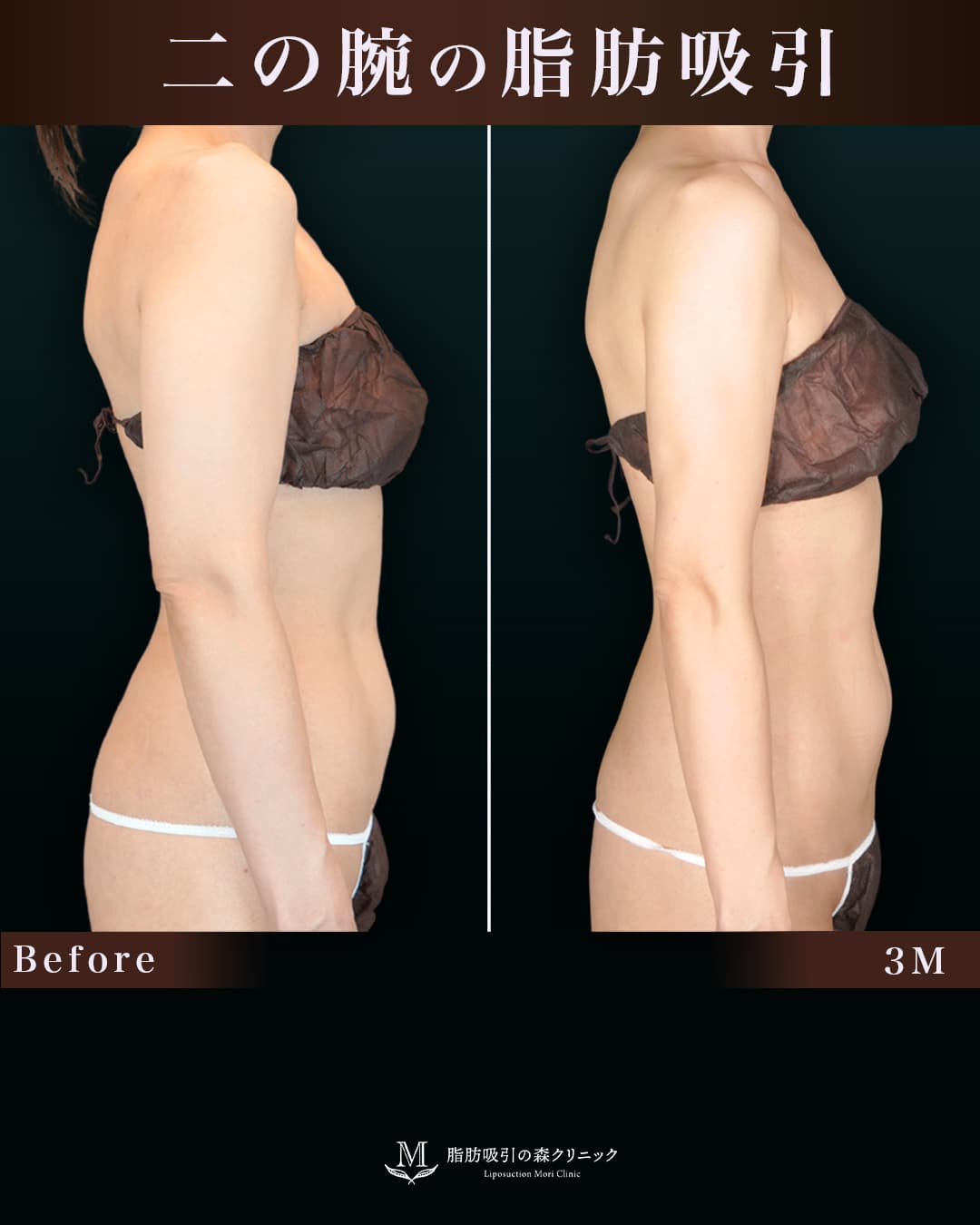 156cm 49kg 40代 二の腕・肩 術後3ヶ月の症例写真