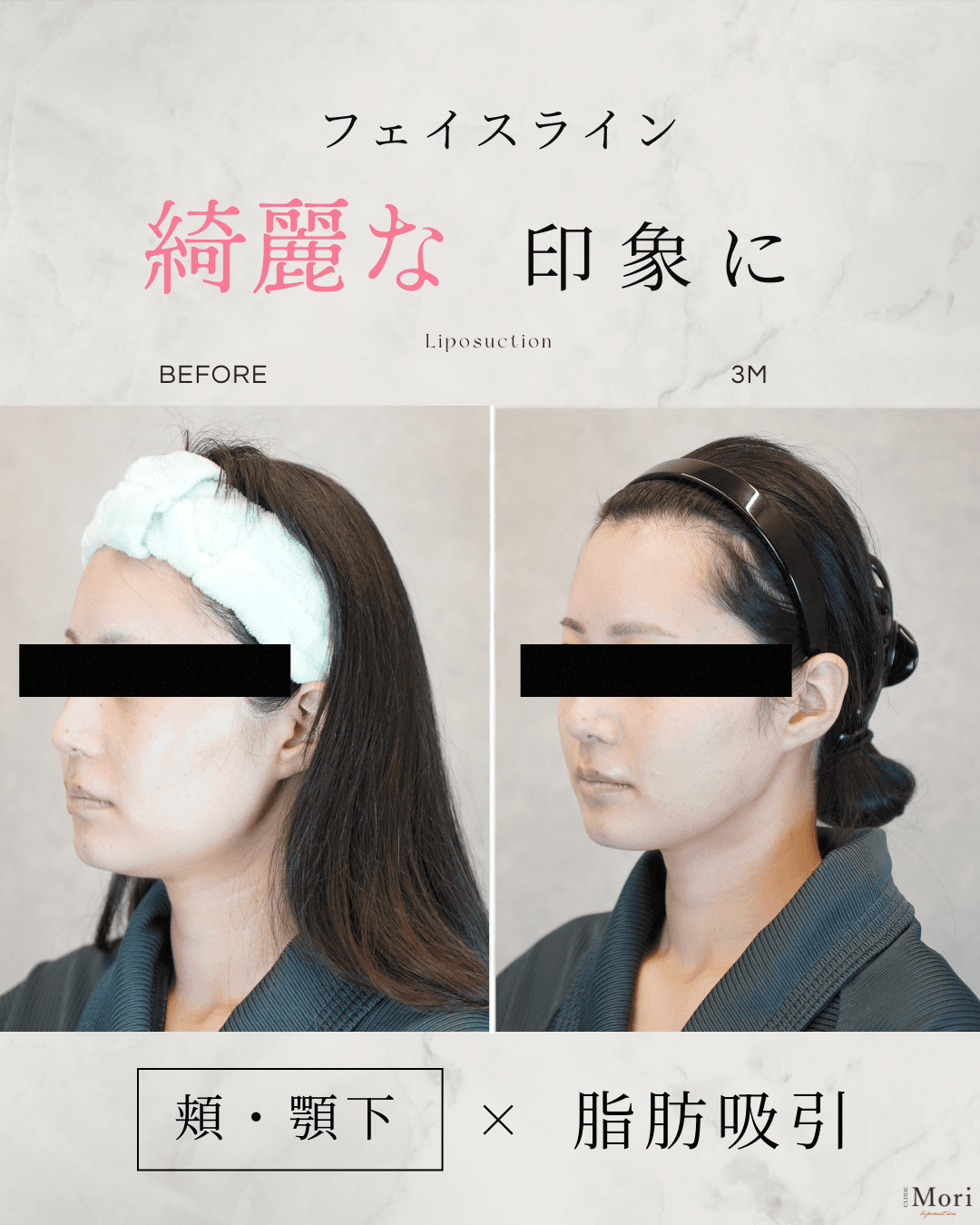 154cm 53kg 30代 頬・顎下 術後3ヶ月の症例写真