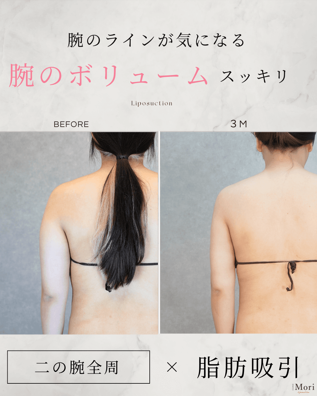 156cm 49kg 40代 二の腕・肩 術後3ヶ月の症例写真