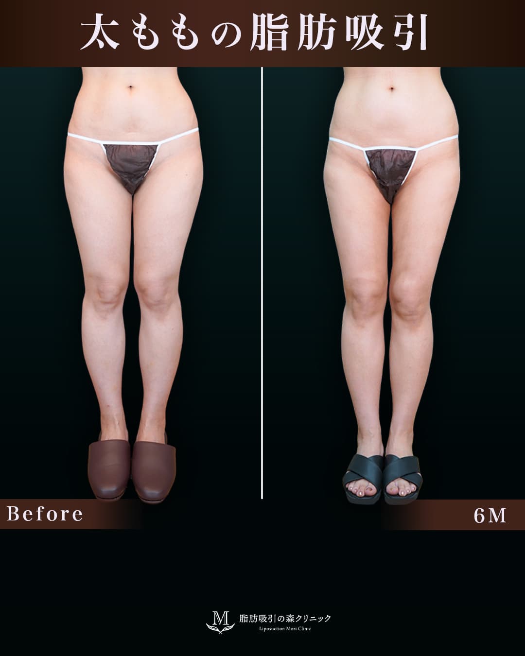156cm 49kg 40代 太もも•膝•臀部 術後6ヶ月の症例写真
