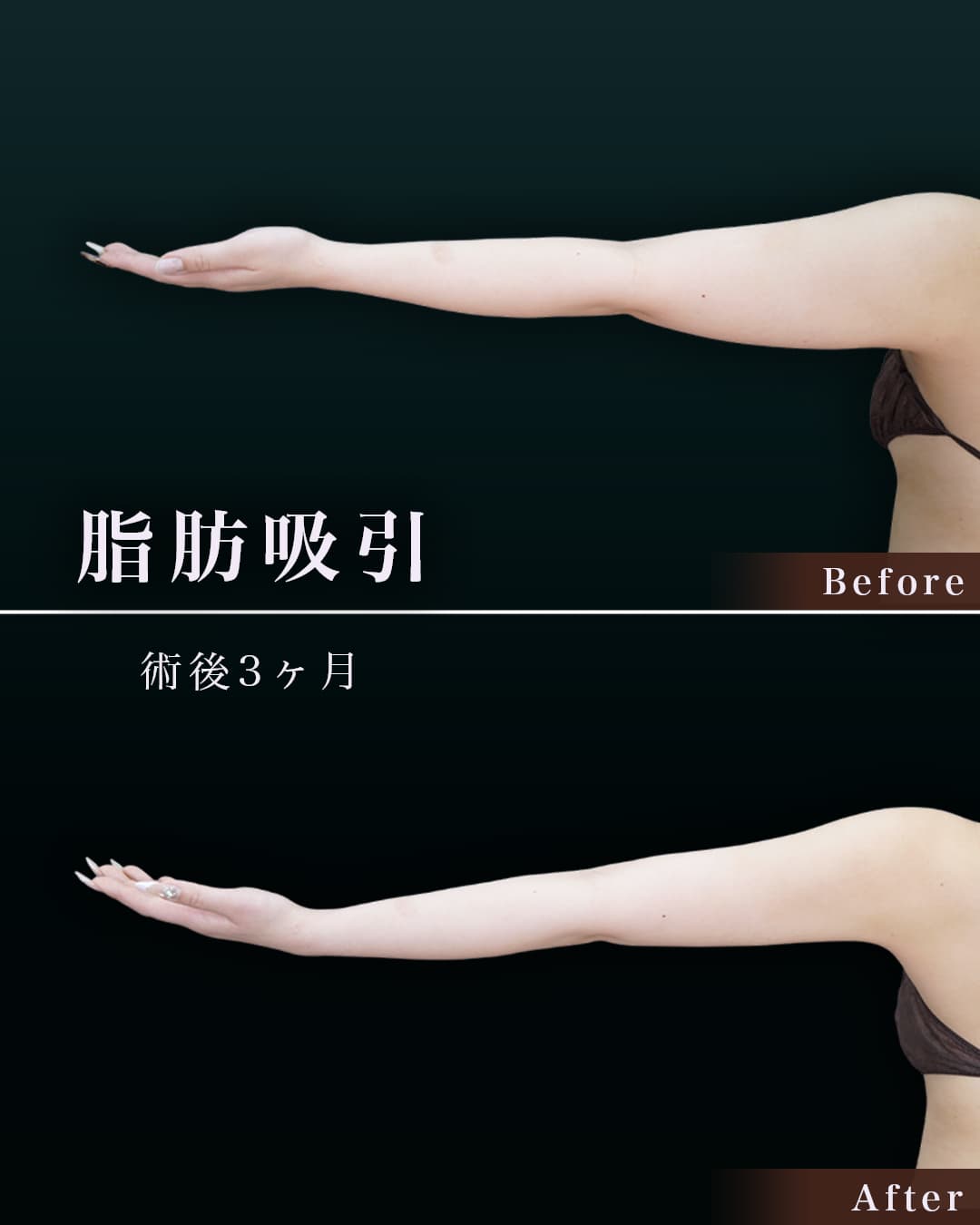 160cm 58kg 20代前半 二の腕・肩 3ヶ月の症例写真