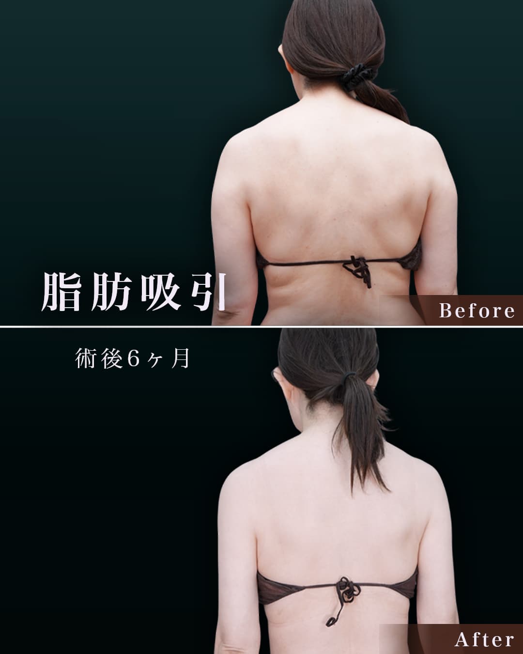 165㎝ 63㎏50代 上腕・肩、付け根 術後6ヶ月の症例写真
