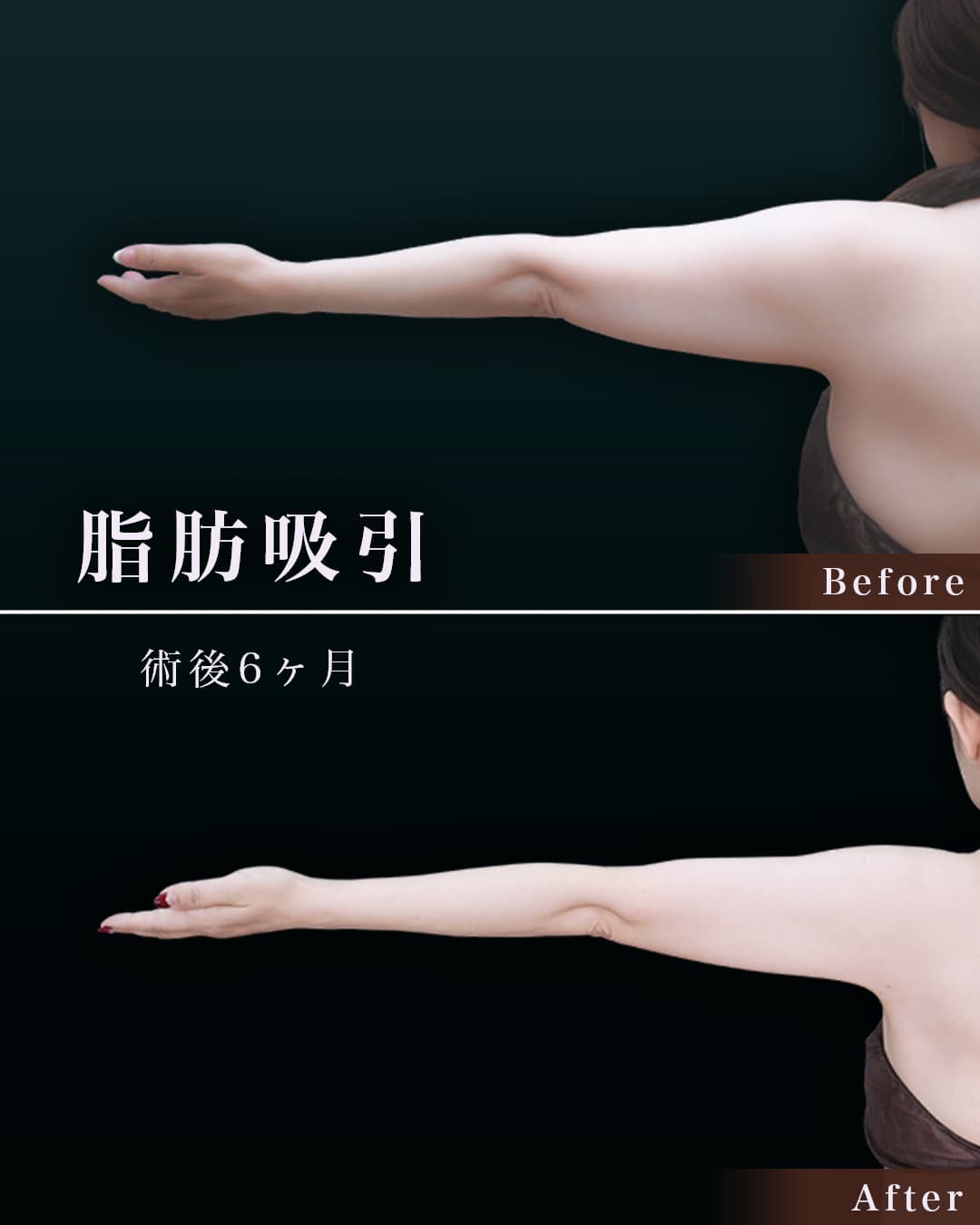 165㎝ 63㎏50代 上腕・肩、付け根 術後6ヶ月の症例写真
