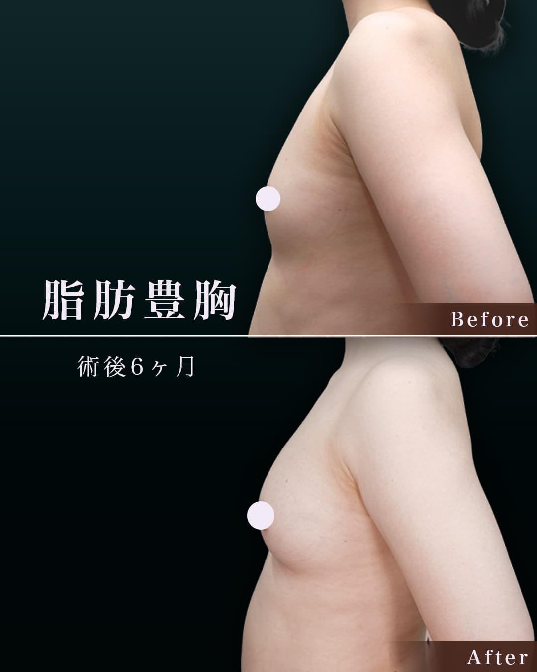 161㎝ 57㎏ 30代 豊胸後6ヶ月の症例写真