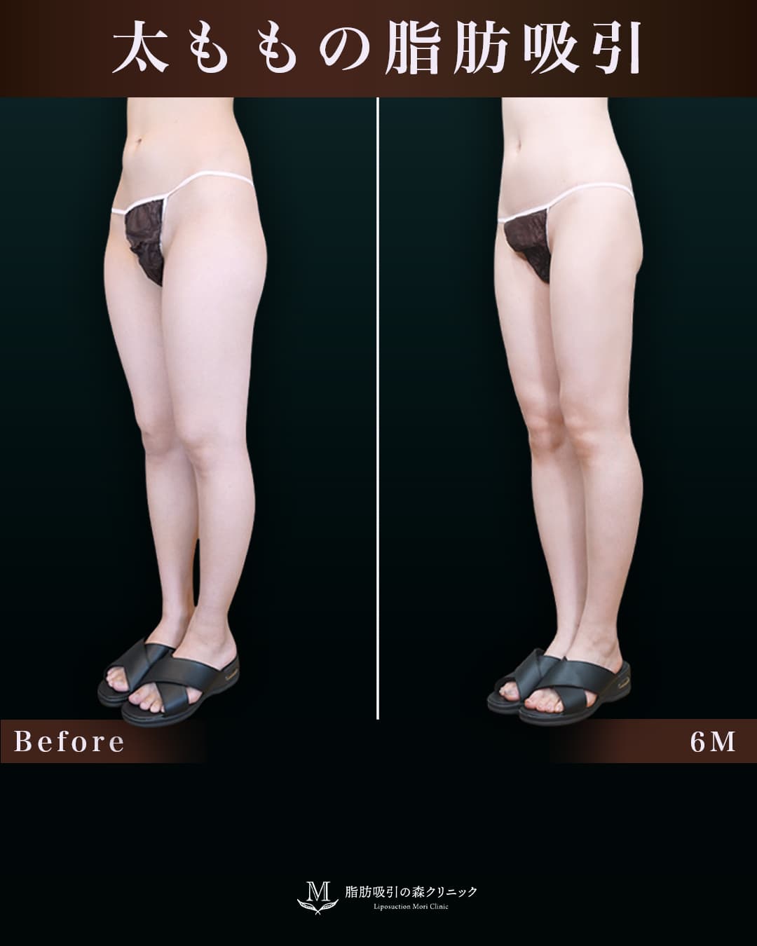 162㎝49㎏20代 大腿全周・膝・臀部 術後6か月の症例写真