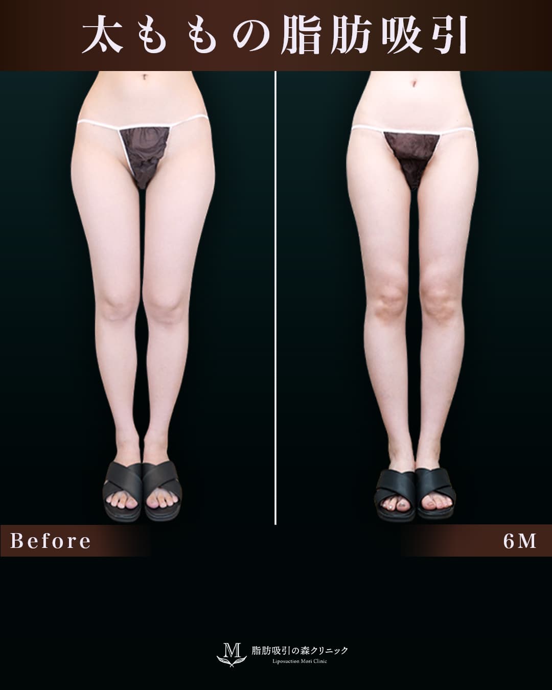 162㎝49㎏20代 大腿全周・膝・臀部 術後6か月の症例写真
