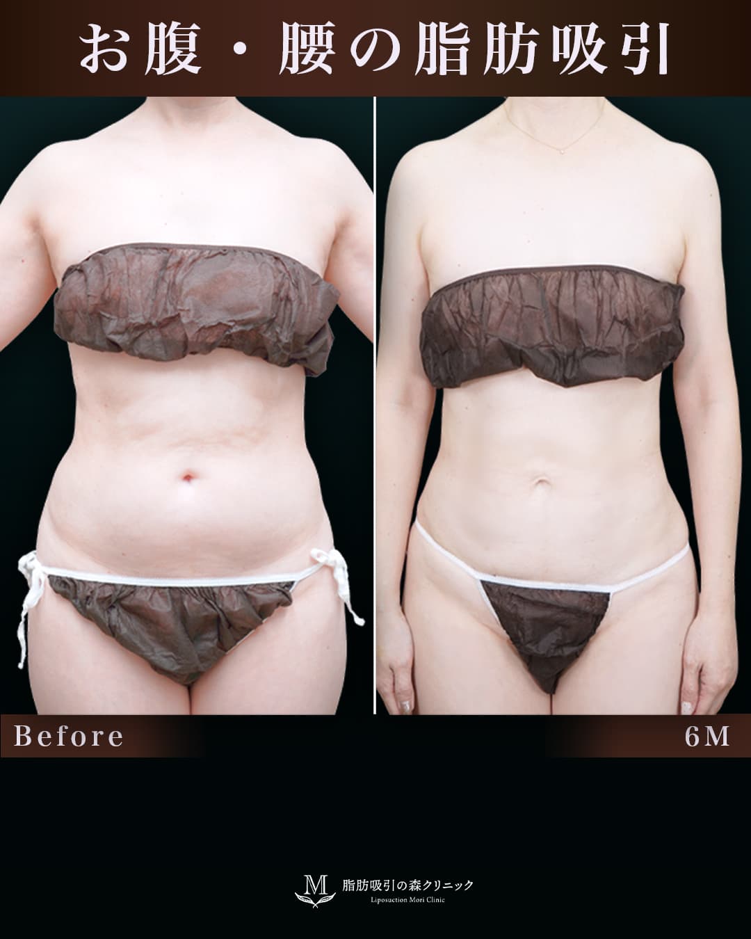 154㎝49㎏50代 胸下・腹部全体・腰 術後6か月の症例写真