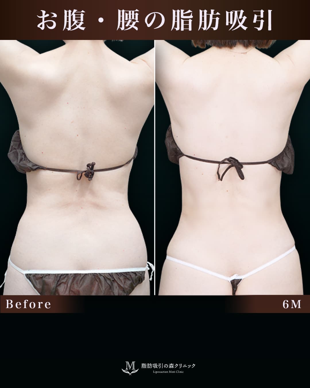 154㎝49㎏50代 胸下・腹部全体・腰 術後6か月の症例写真