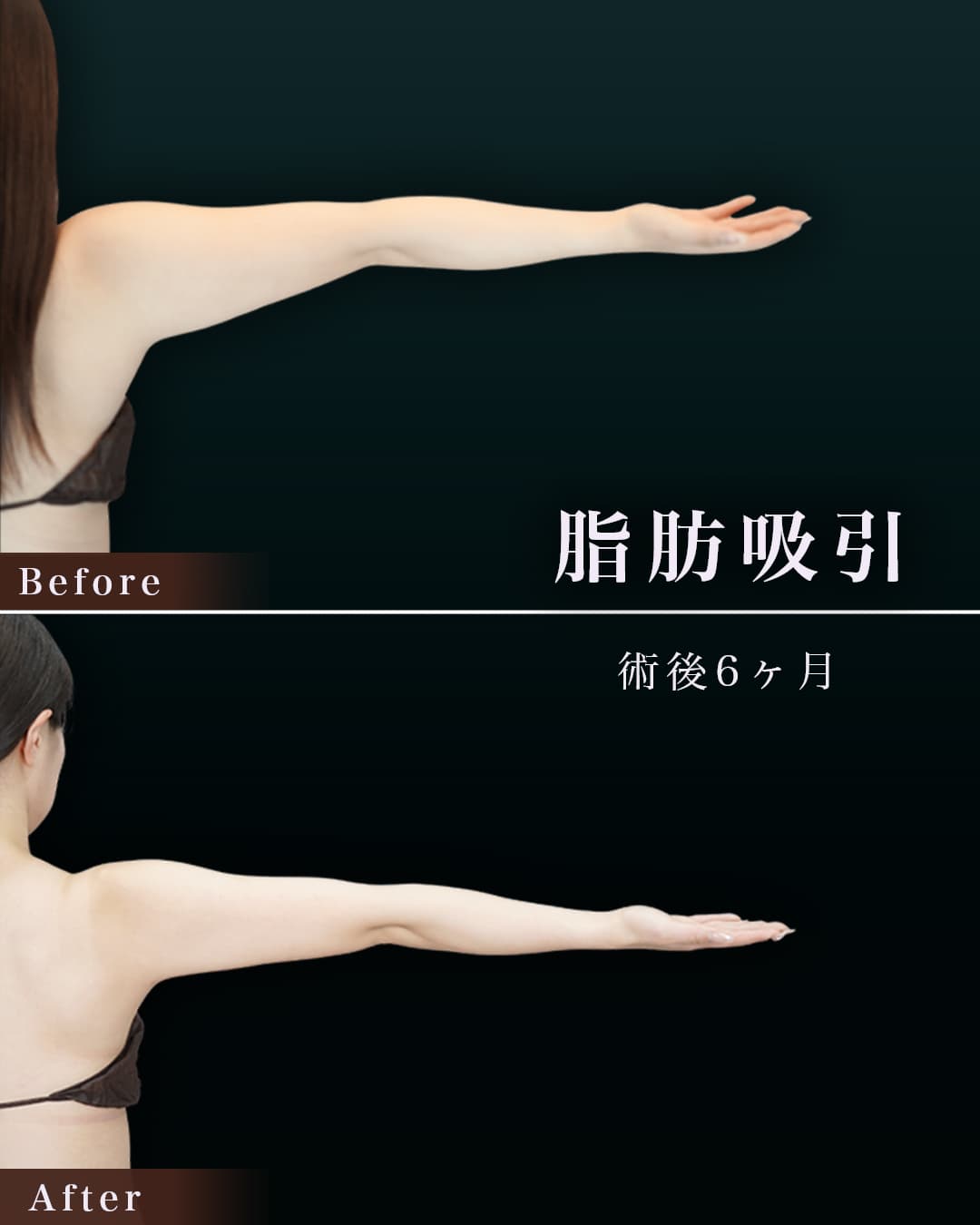 162㎝58㎏20代 上腕・肩、脇肉、付け根 術後6か月の症例写真