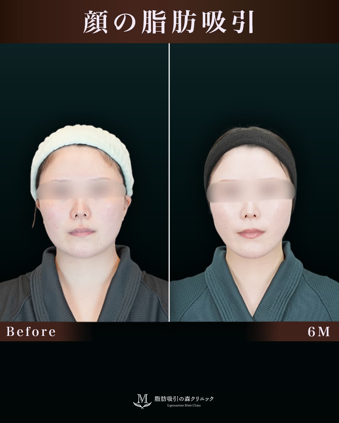 162㎝63㎏30代 頬・顎下 術後6か月の症例写真