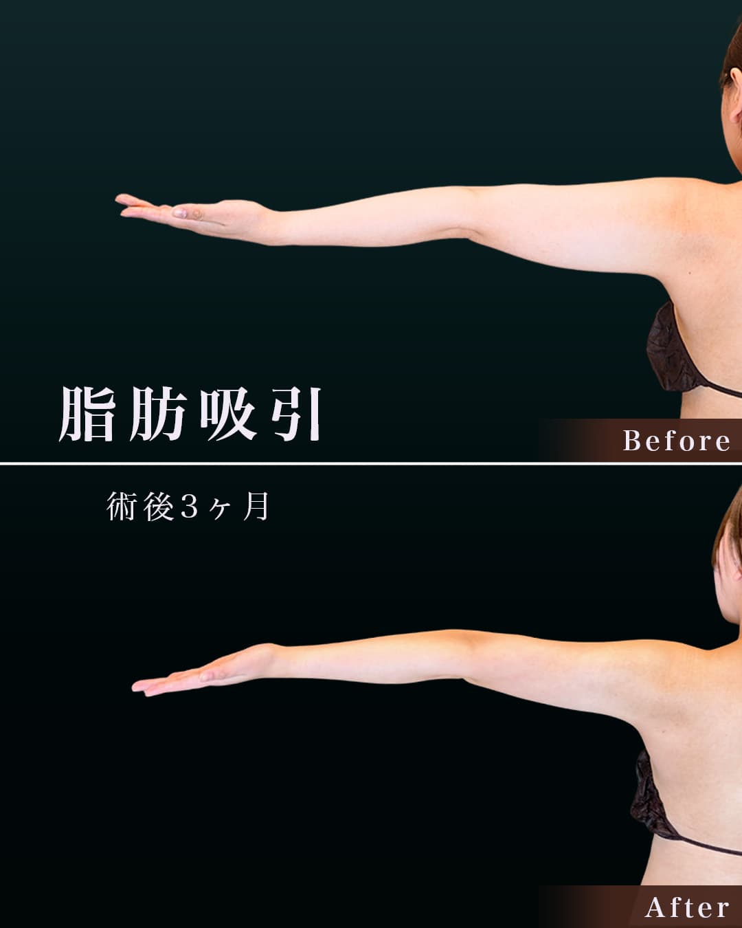 159㎝54㎏20代 上腕全周 術後6か月の症例写真