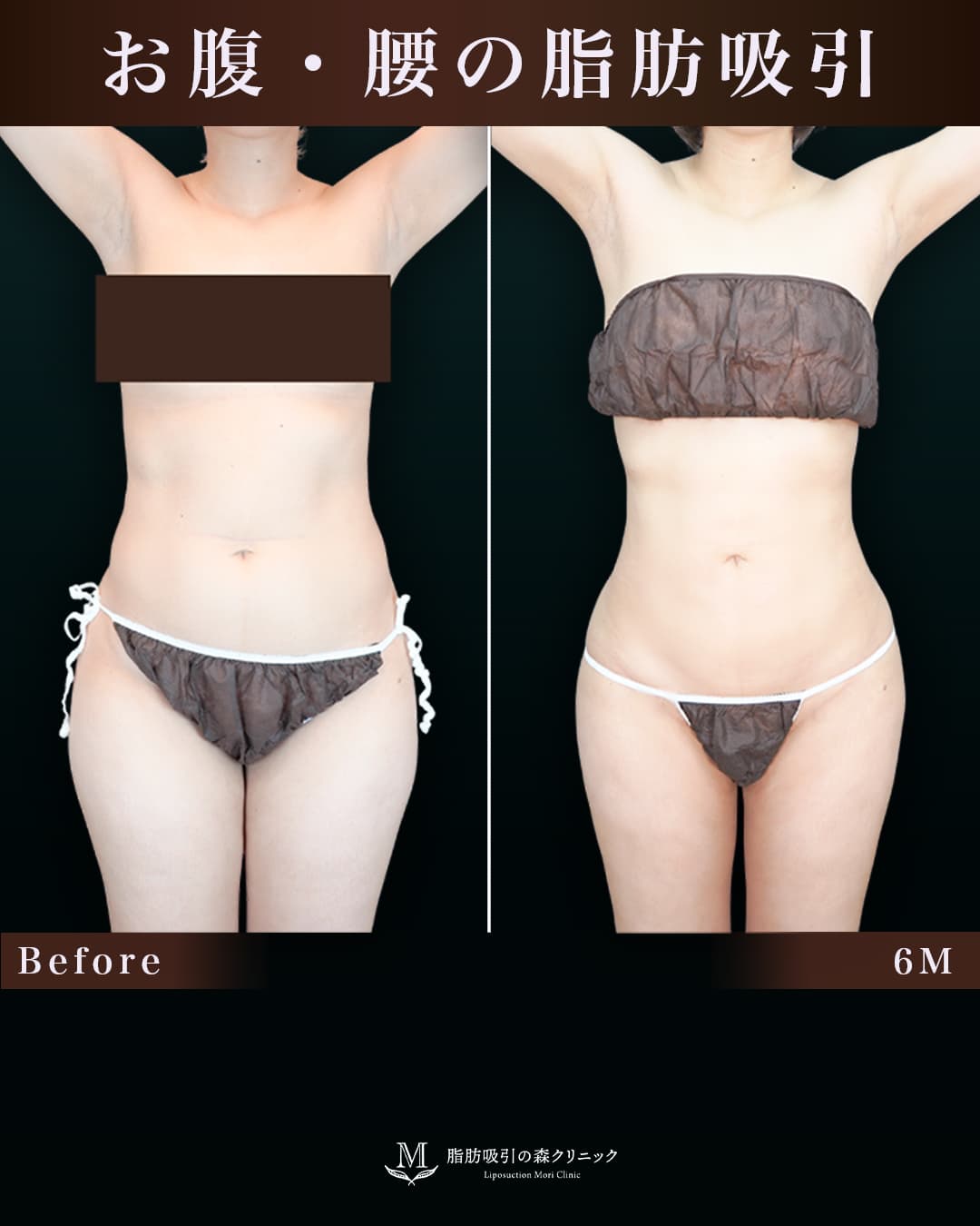 155㎝54㎏40代 胸下・腹部全体・腰 術後6か月