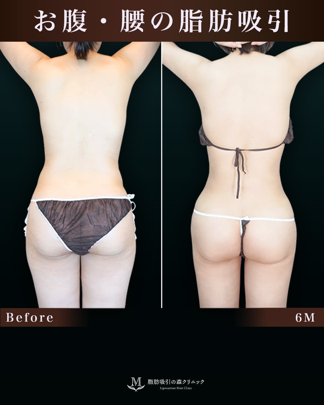 155㎝54㎏40代 胸下・腹部全体・腰 術後6か月の症例写真