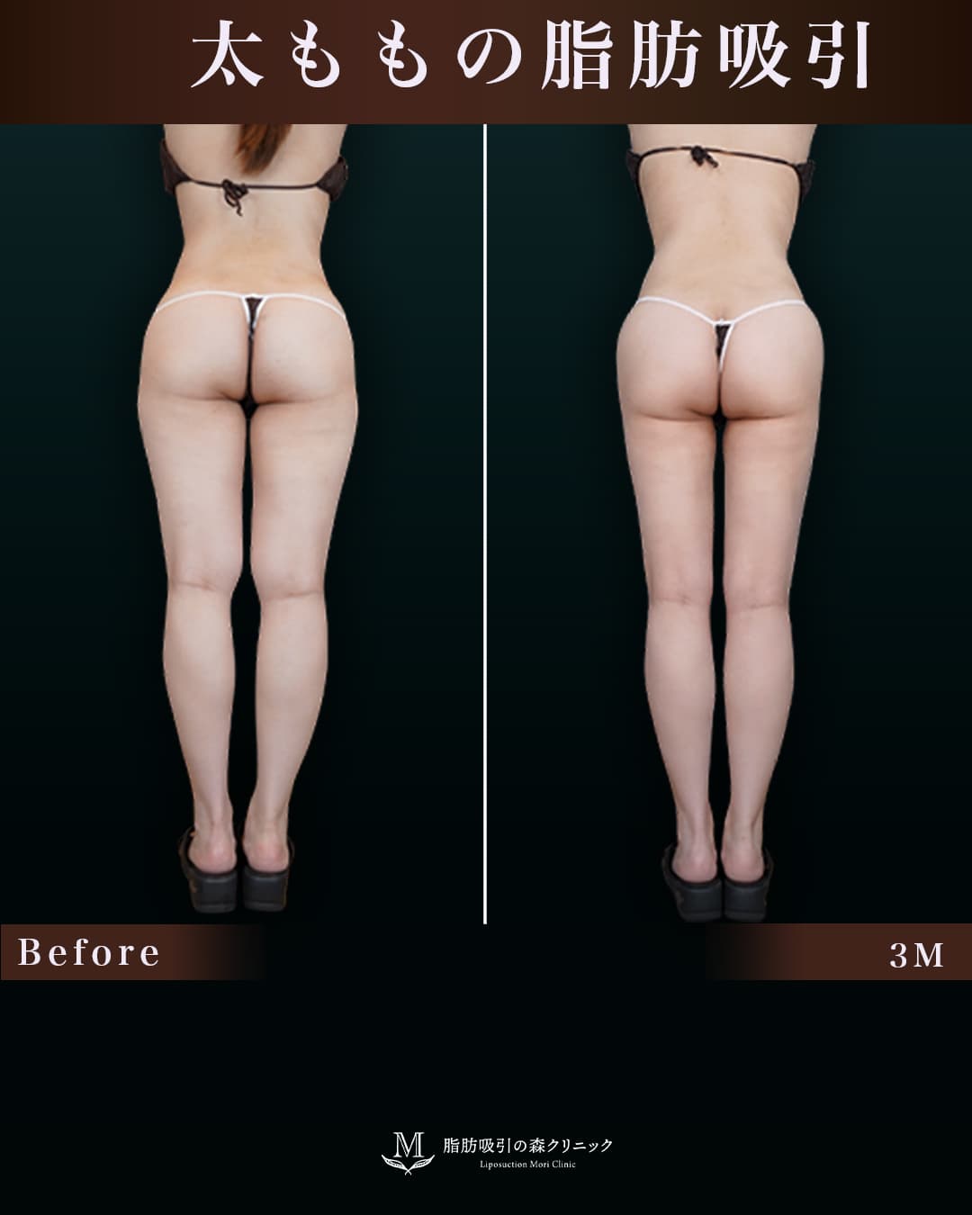 159㎝55㎏20代 大腿全周・膝・臀部 術後3ヶ月
