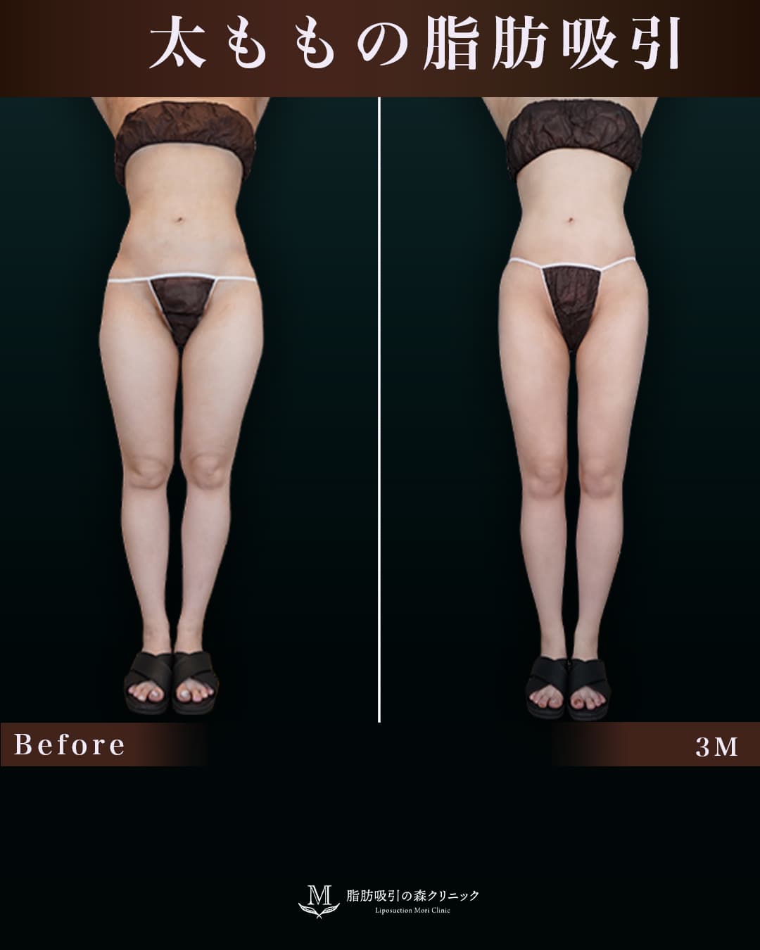 159㎝55㎏20代 大腿全周・膝・臀部 術後3ヶ月の症例写真