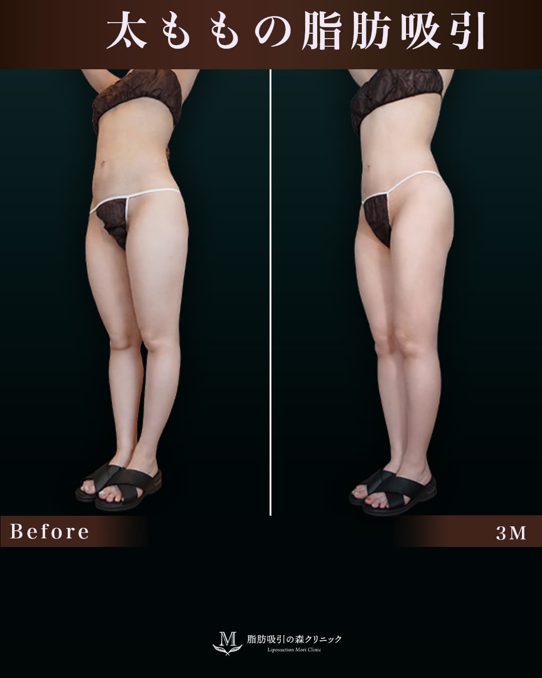 159㎝55㎏20代 大腿全周・膝・臀部 術後3ヶ月の症例写真