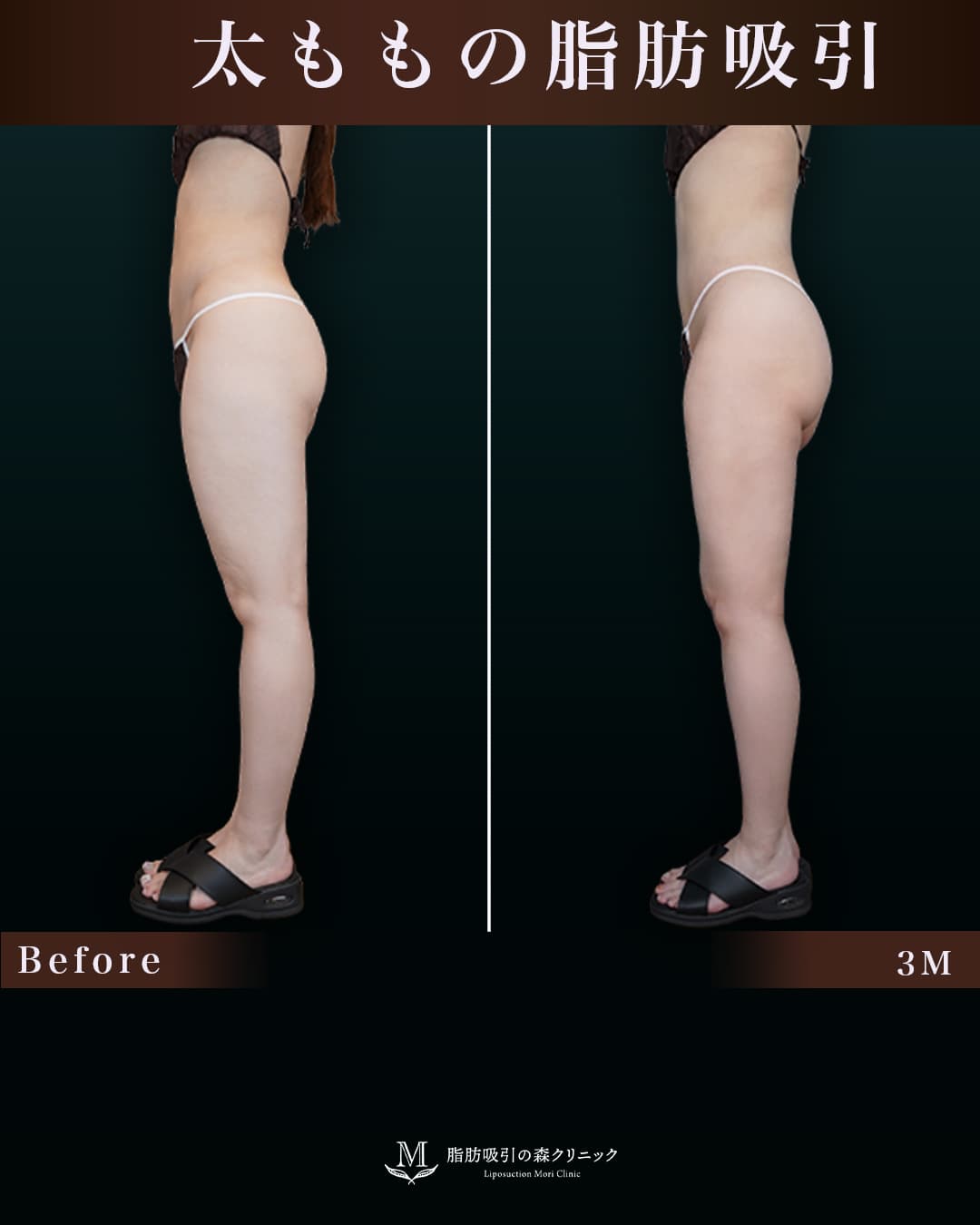 159㎝55㎏20代 大腿全周・膝・臀部 術後3ヶ月の症例写真