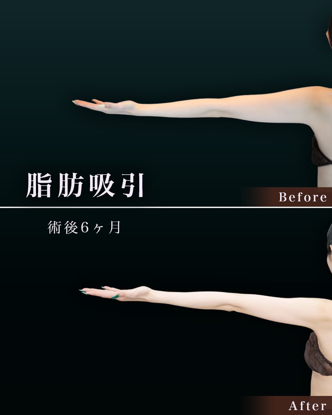 172㎝56㎏30代 上腕・肩、付け根 術後6か月の症例写真