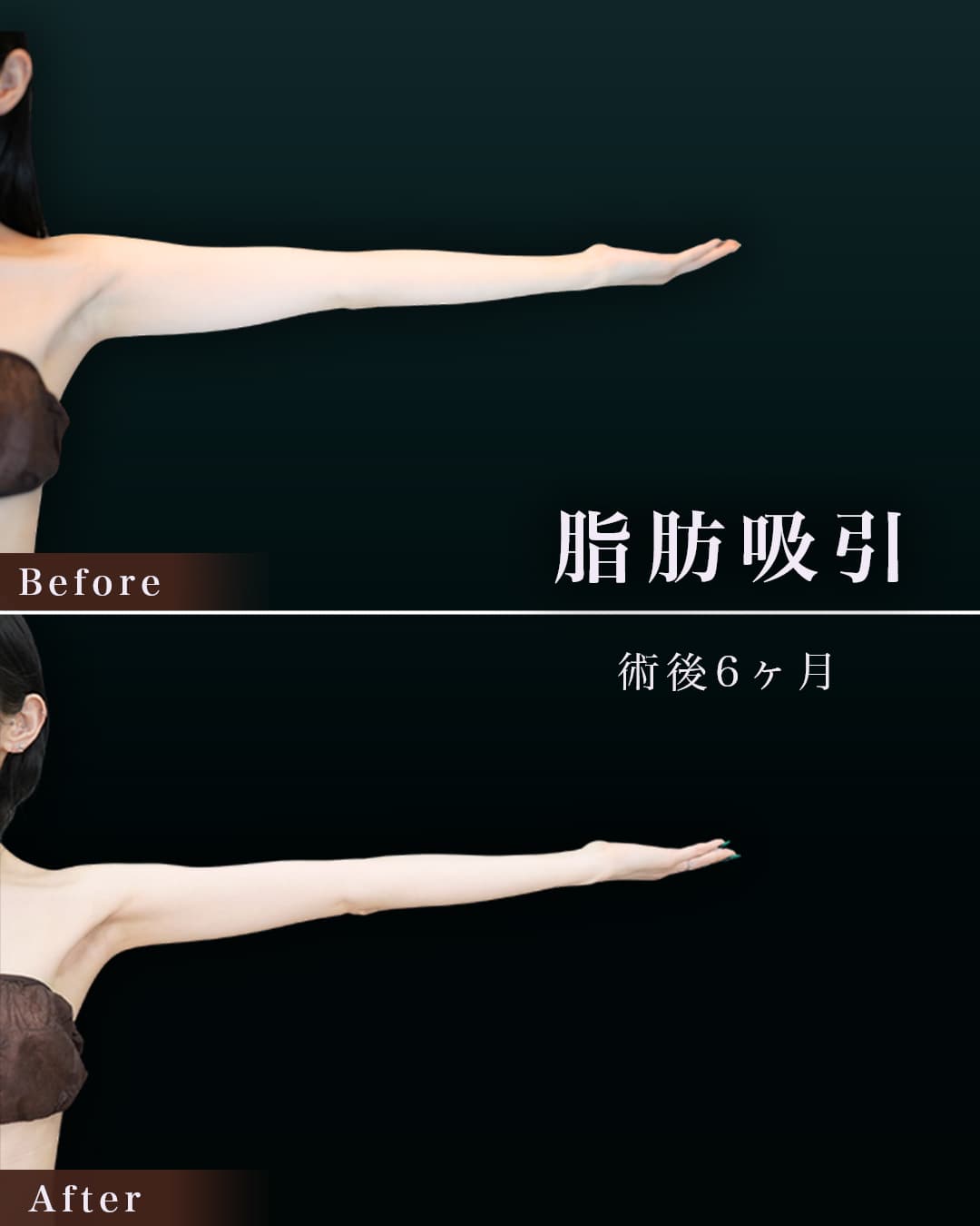 172㎝56㎏30代 上腕・肩、付け根 術後6か月の症例写真
