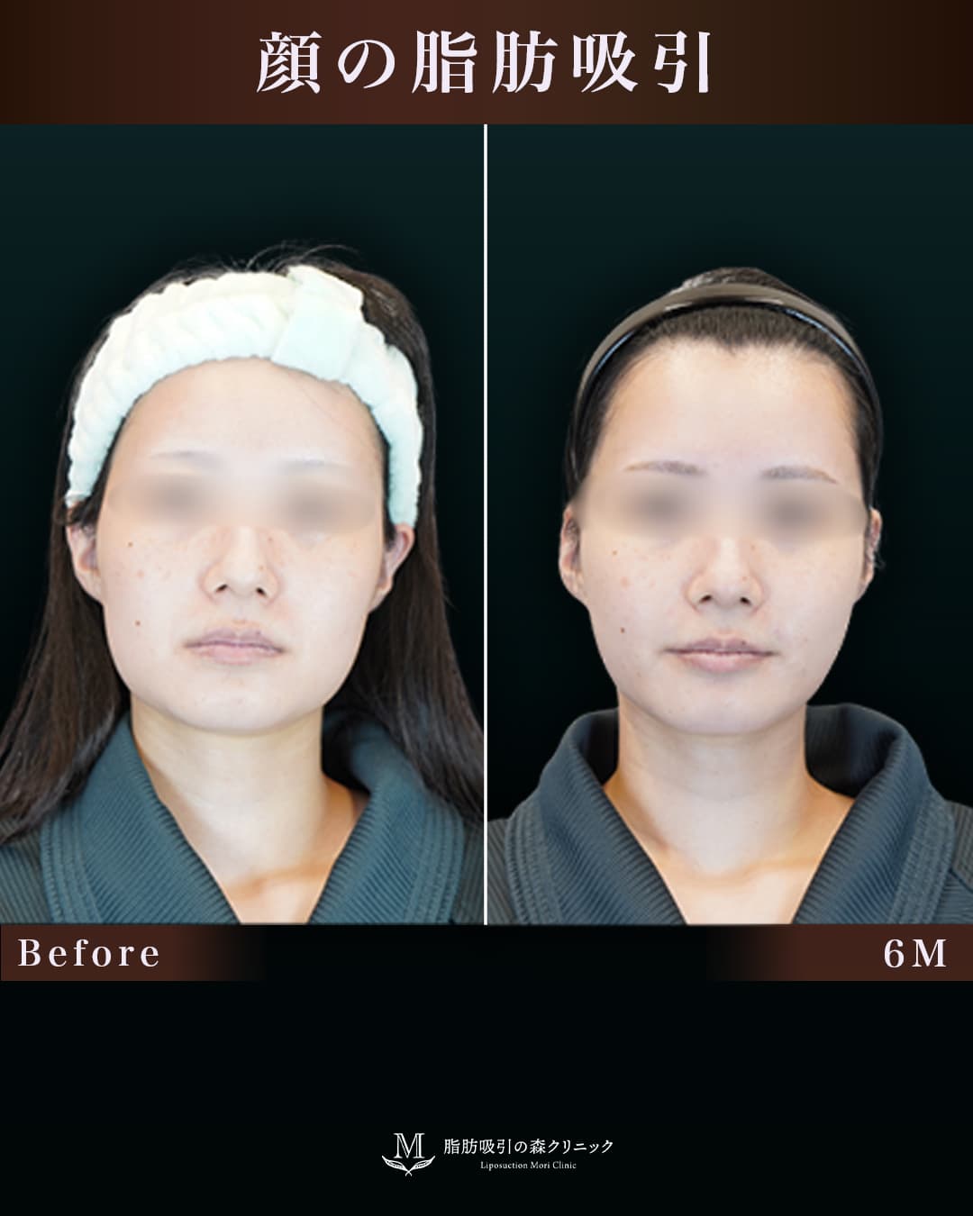 167㎝55㎏20代 頬・顎下 術後6か月の症例写真