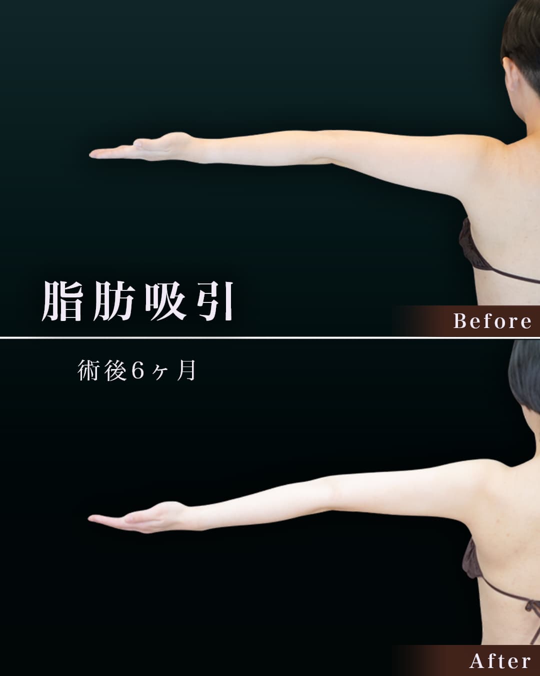 161㎝53㎏20代 上腕・肩 術後6か月の症例写真