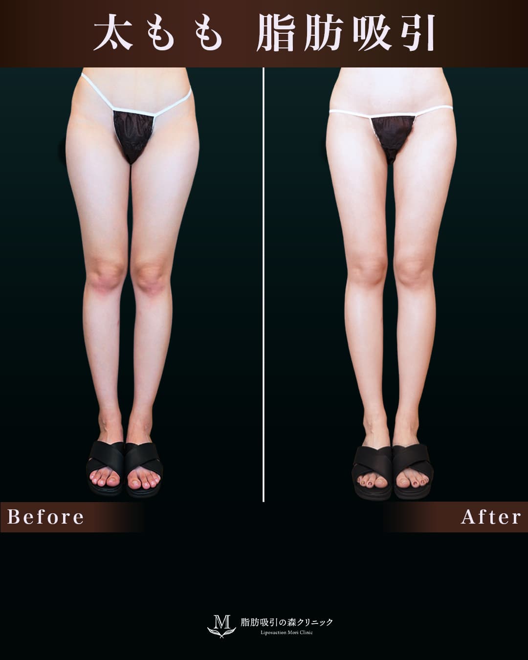 168㎝56㎏30代 大腿全周・臀部 術後1か月の症例写真