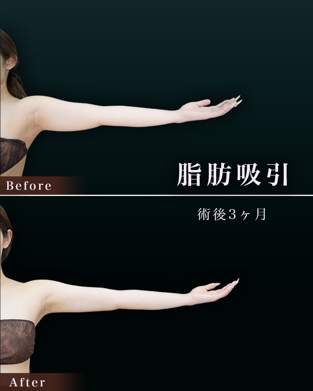 160㎝58㎏20代 上腕・肩 術後3か月の症例写真