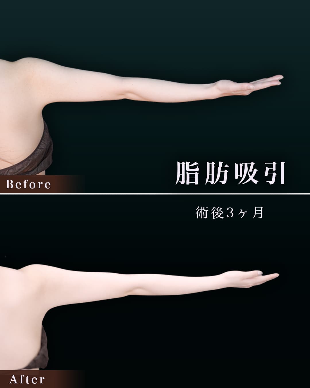 165㎝49㎏20代 上腕・肩、付け根 術後3か月の症例写真