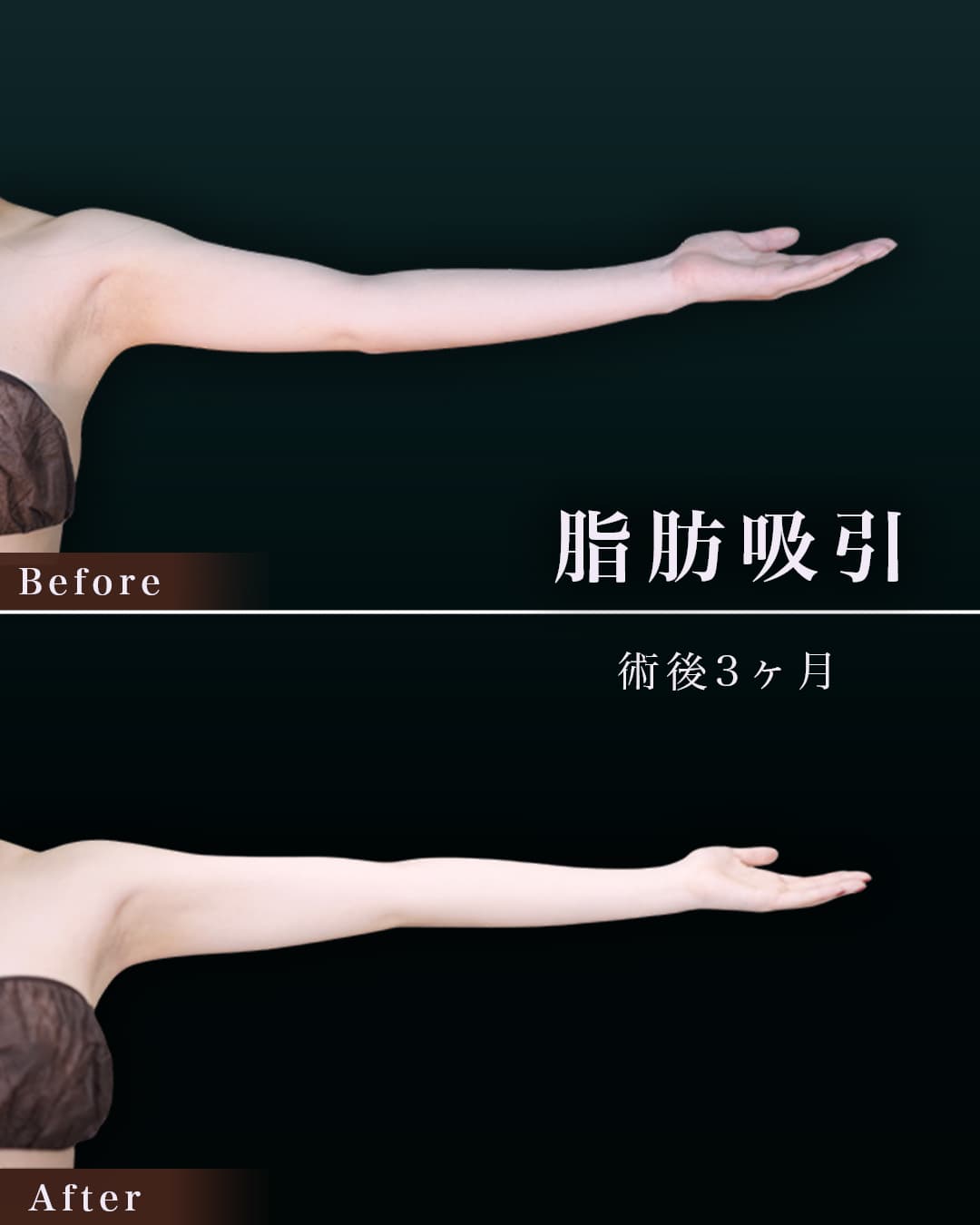 165㎝49㎏20代 上腕・肩、付け根 術後3か月の症例写真